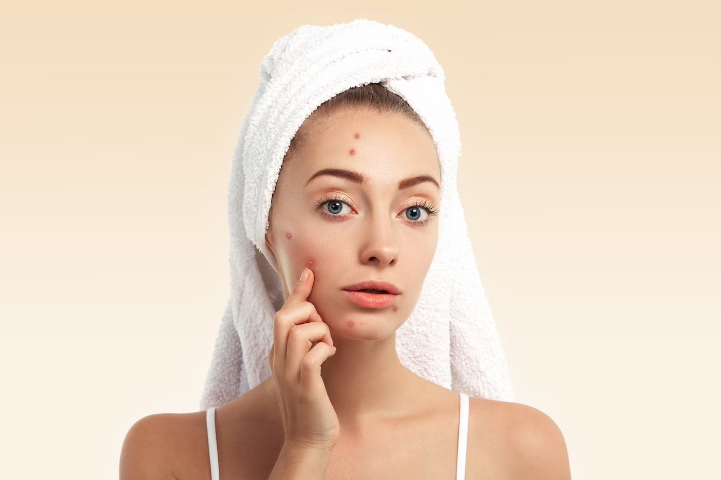 Mild Acne treatment