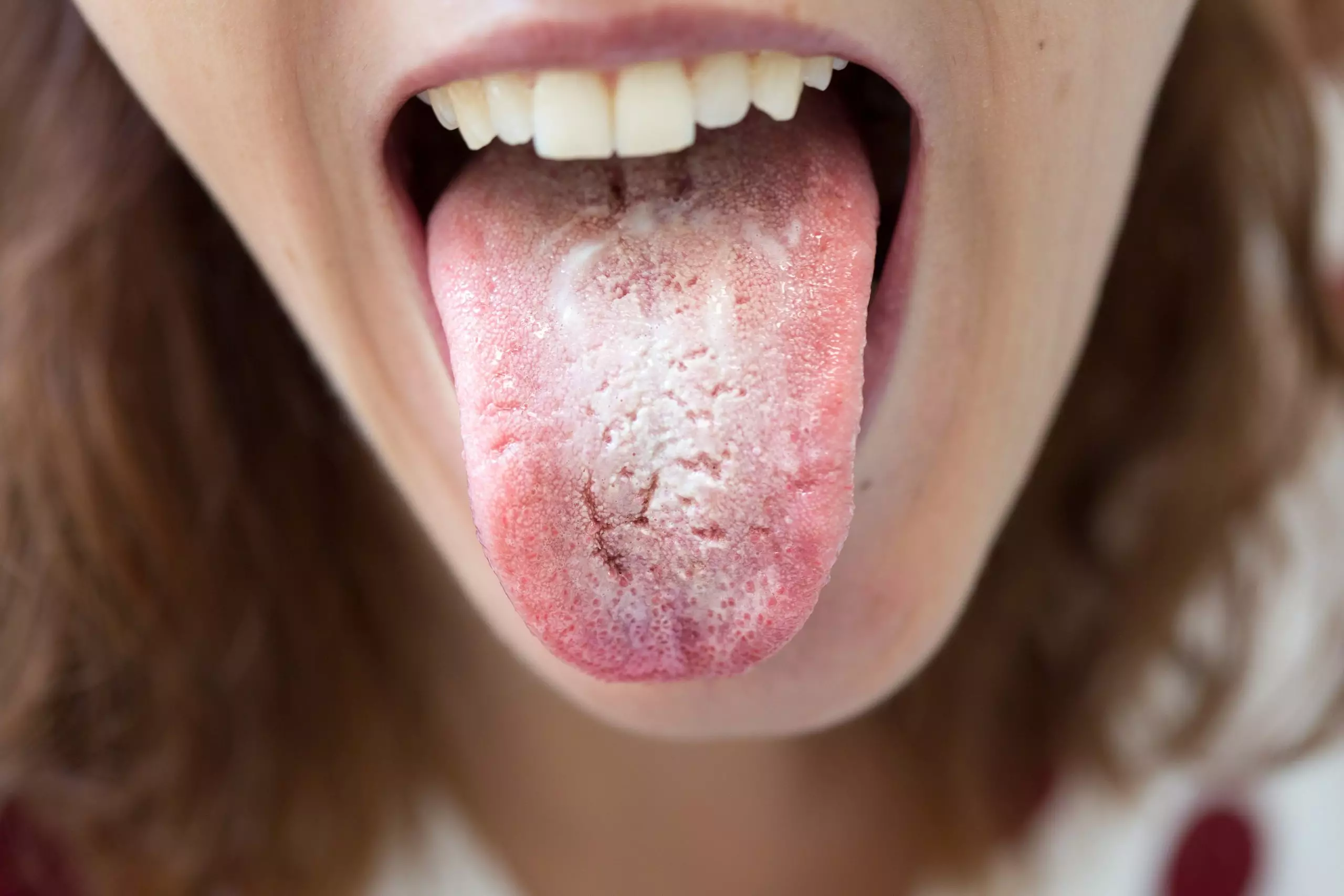 Candidal stomatitis treatment
