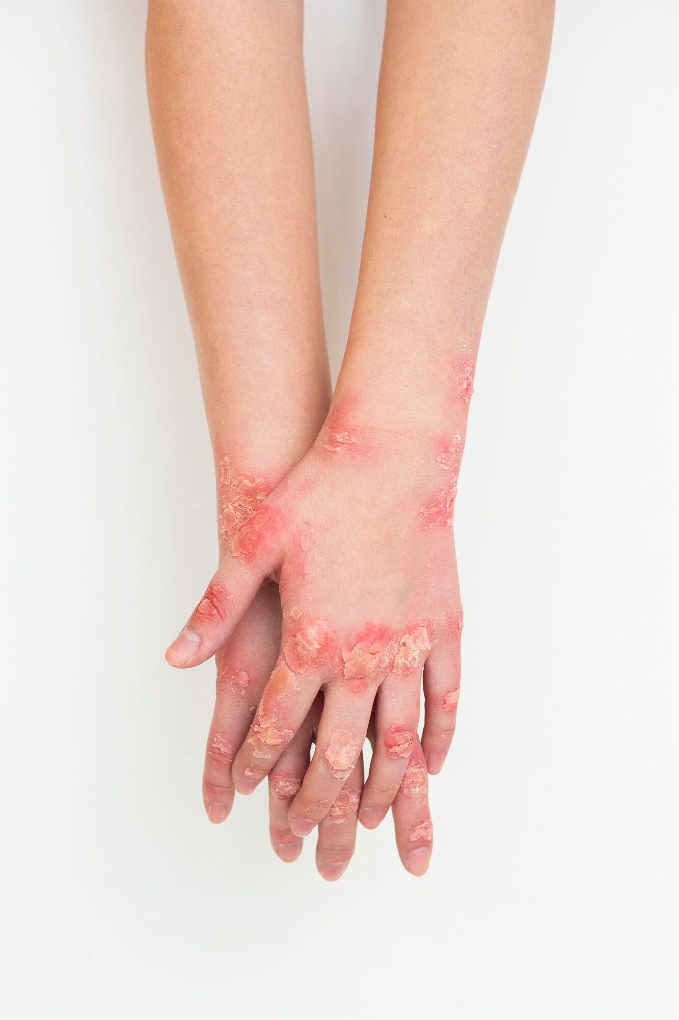Dermatitis treatment