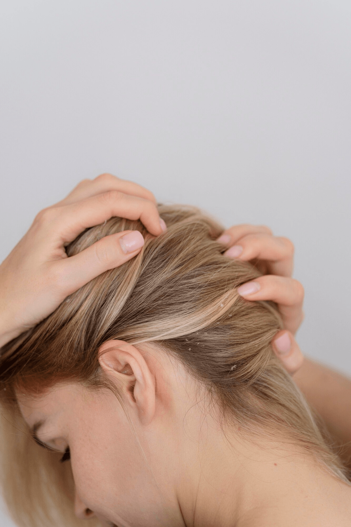 Dandruff treatment
