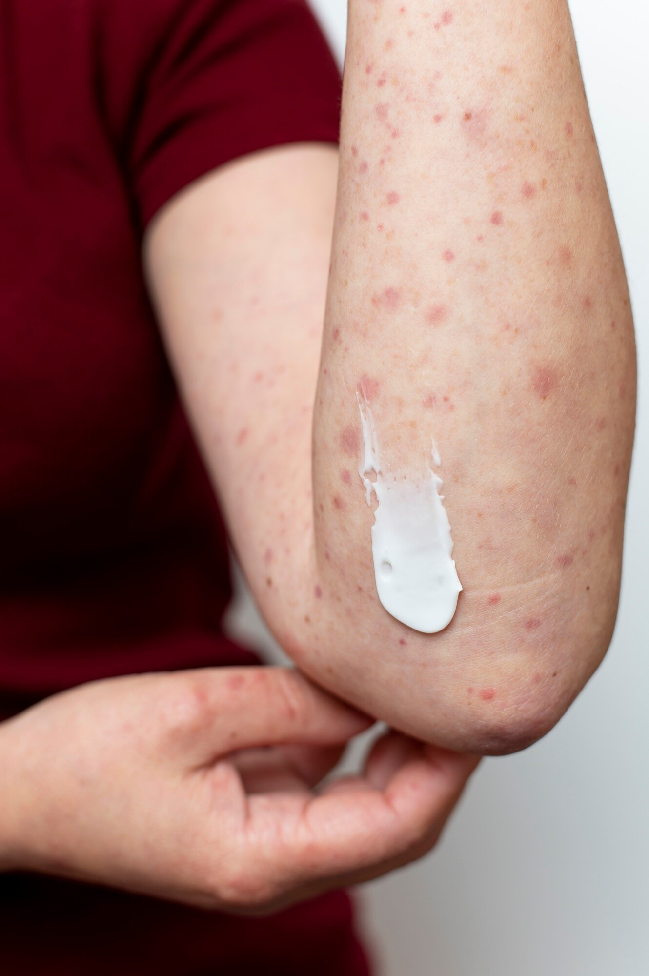 Impetigo treatment