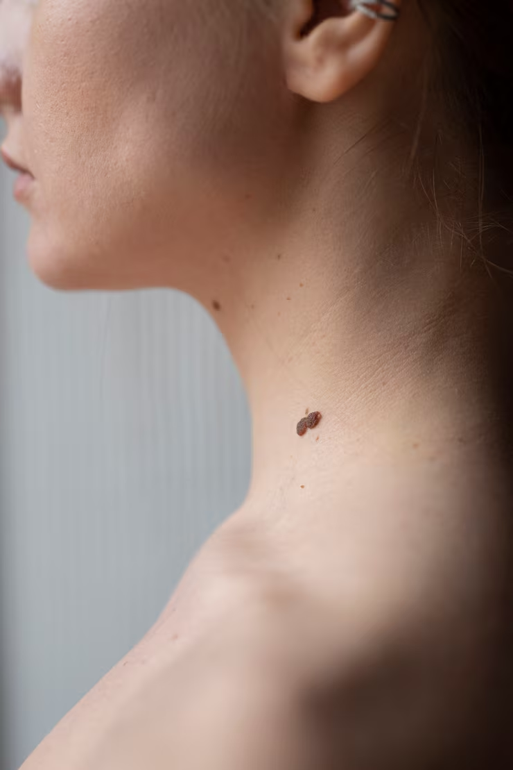 Warts treatment