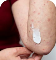 Impetigo treatment