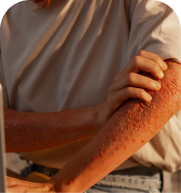 Shingles treatment