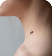 Warts treatment